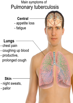 Tuberkolose