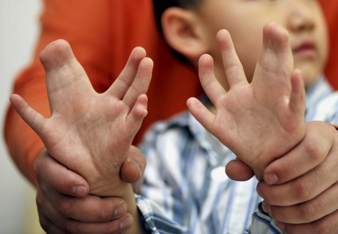 finger-mutasjon